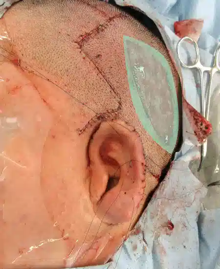 17/October/2023 耳垂残存型小耳症（左耳）の耳立て手術頭皮分層皮膚を採取しています。
