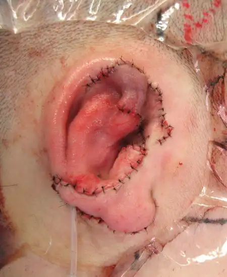 ３次元肋軟骨フレームを皮下ポケットへ移植して再建した耳介。