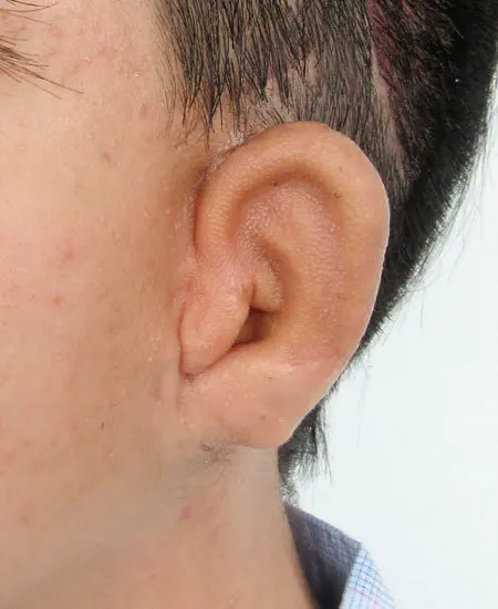 17/October/2023 耳垂残存型小耳症（左耳）の耳立て手術　術後3週間