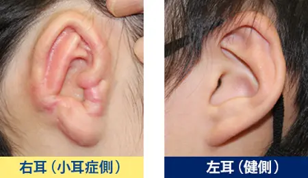この患者様は、再建耳の対耳輪を通常の患者様に比べてまっすぐに作っています。 これは反対側（健側）の耳の形に合わせて作成したためです。