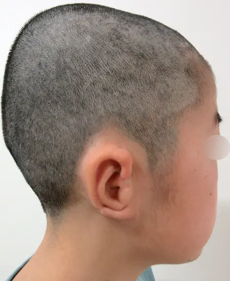 2024年1月16日小耳甲介型小耳症（右耳）の耳立て手術