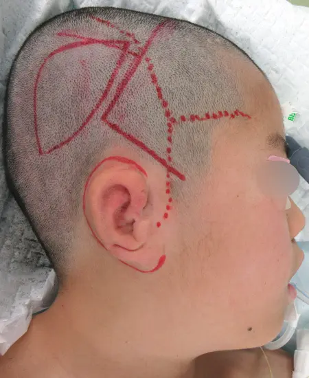 2024年1月16日小耳甲介型小耳症（右耳）の耳立て手術　デザイン