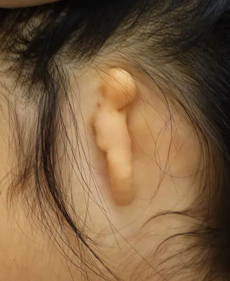 2023年1月31日 耳垂残存型小耳症の肋軟骨移植術