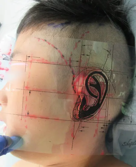 2023年1月31日 耳垂残存型小耳症の肋軟骨移植術
透明フイルムに印刷した本人サイズの設計図を用いて
耳介の正常な場所と大きさを決定する。
