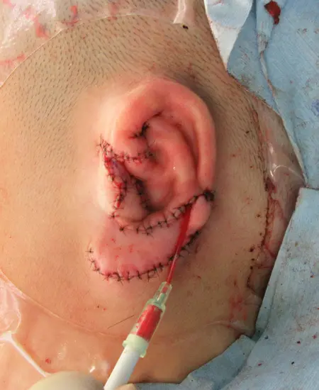 2023年1月31日 耳垂残存型小耳症の肋軟骨移植術３次元肋軟骨フレームを
　皮下ポケットへ移植して再建した耳介。
