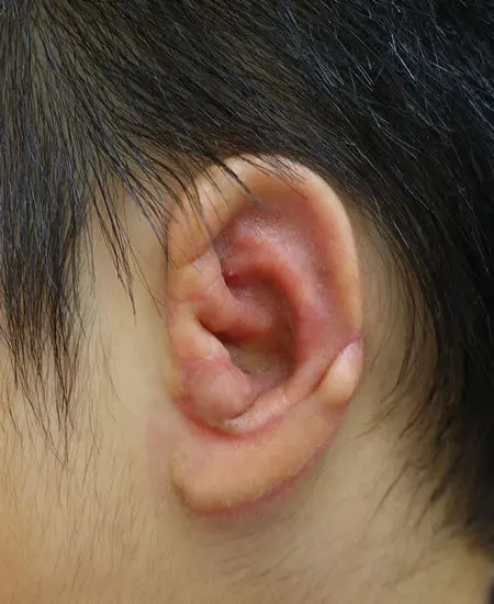 2023年1月31日 耳垂残存型小耳症の肋軟骨移植術術後　約１カ月半