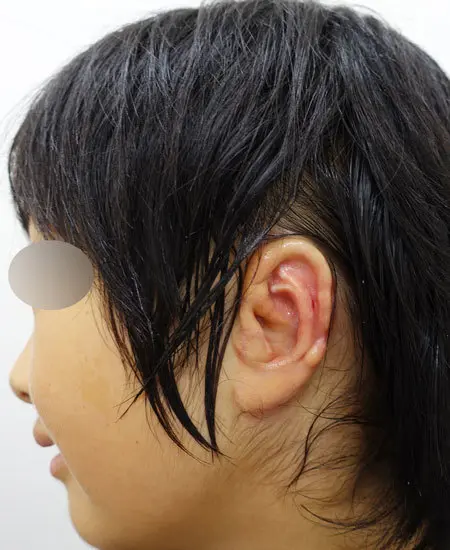 2023年1月31日 耳垂残存型小耳症の肋軟骨移植術術後　約6カ月