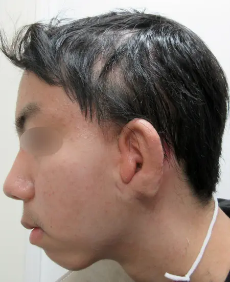 17/October/2023 耳垂残存型小耳症（左耳）の耳立て手術　術後2.5月
