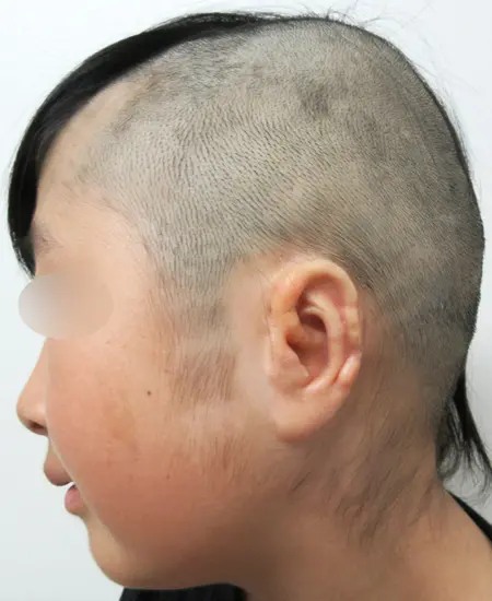 2024年2月6日耳垂残存型小耳症（左耳）の耳立て手術 手術前