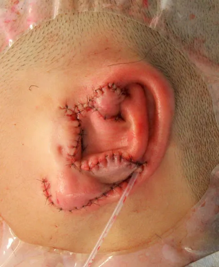 ３次元肋軟骨フレームを皮下ポケットへ移植して再建した耳介