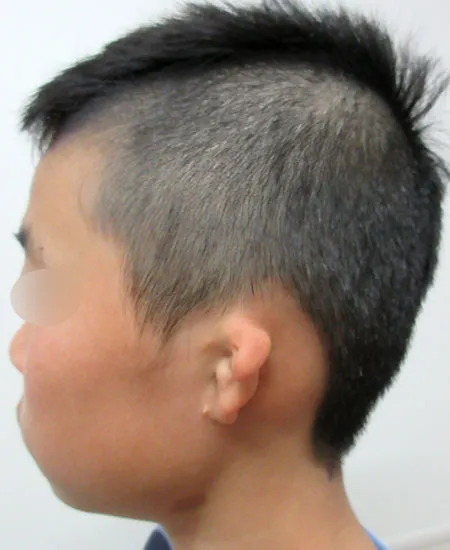 耳垂残存型小耳症（左耳）の肋軟骨移植術