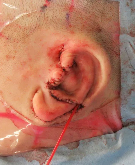 ３次元肋軟骨フレームを皮下ポケットへ移植して再建した耳介