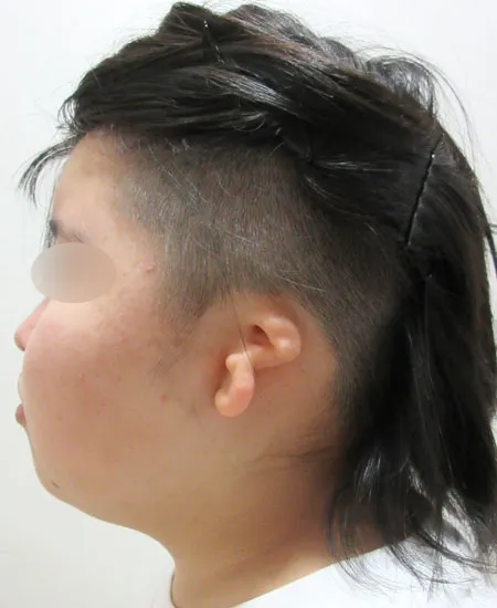 耳垂残存型小耳症（左耳）の肋軟骨移植術