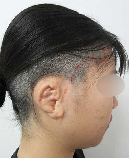 NMさん15歳女児の2回目小耳症の術前横向き