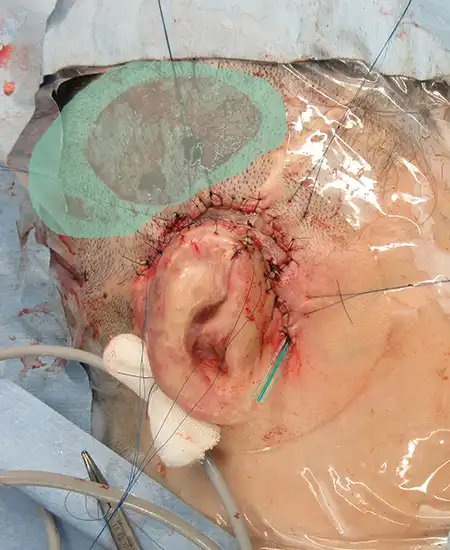 SMさん成人女性の再拳上手術 手術後横から耳全体を見たところ