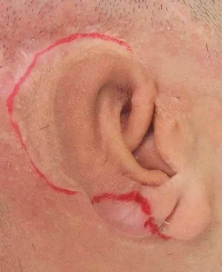耳裏のデザインと瘢痕部分の切除デザイン