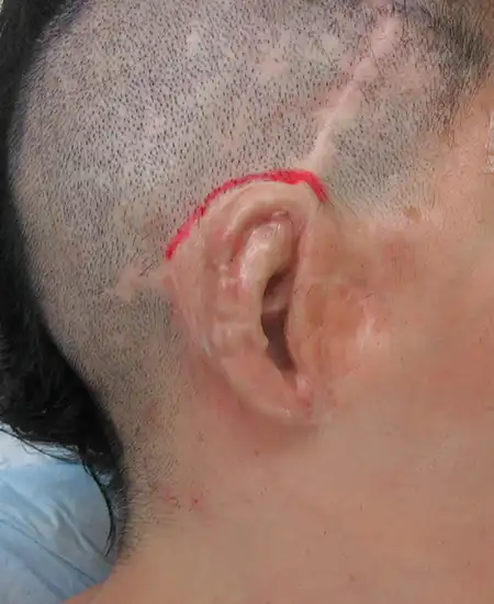 S.Mさん 術前右耳 側面 耳上部にデザインした様子