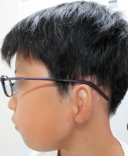両耳小耳症の左側耳立て修正手術　2.5カ月横から眼鏡をかけた写真