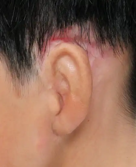 両耳小耳症の左側耳立て修正手術　2.5カ月横から見た耳のみの写真