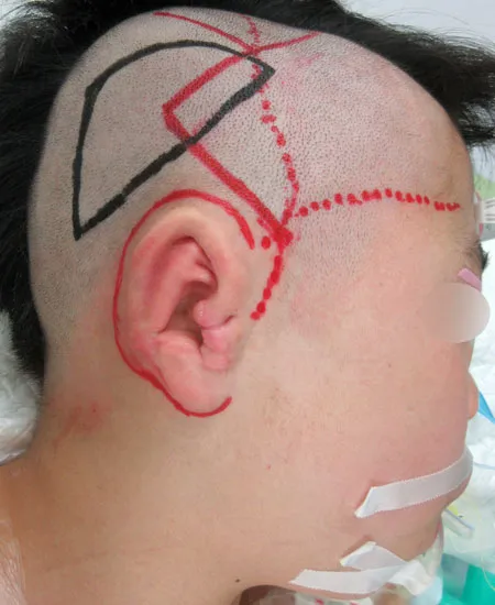 耳介挙上術（耳立て手術）のデザイン