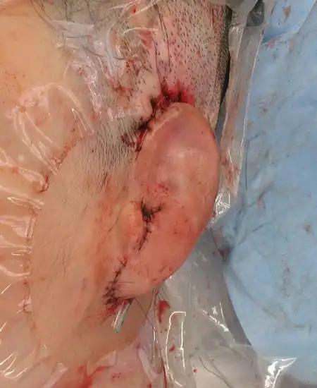 両耳小耳症の左側耳立て修正手術 手術直後 斜め前から