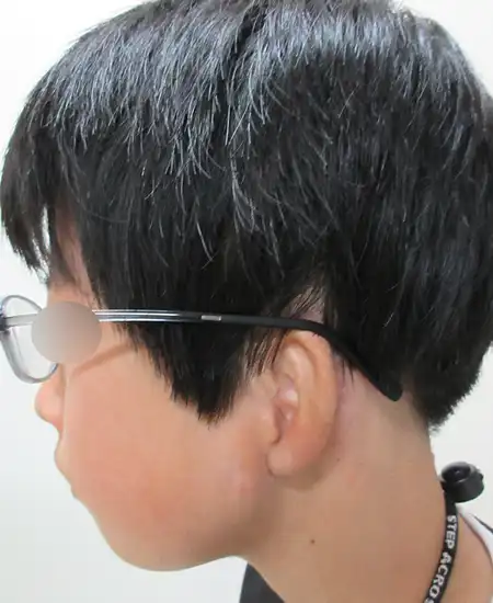 両耳小耳症の左側耳立て修正手術　術後10カ月横から眼鏡をかけた写真