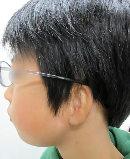 両耳小耳症の左側耳立て修正手術　術後7カ月横から眼鏡をかけた写真