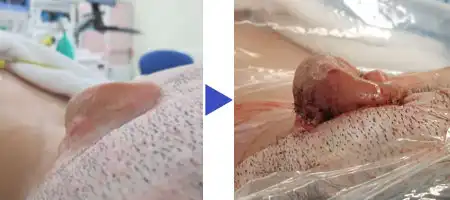 両耳小耳症の左側耳立て修正手術　術前と術後の比較 上から見た様子