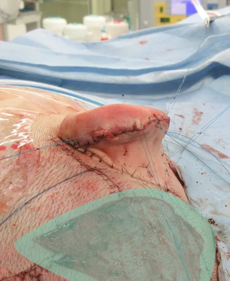 耳介挙上術（耳立て手術）手術後の状態　耳の角度