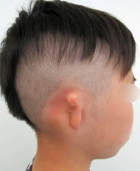 耳垂残存型小耳症右耳の小耳症手術前の状態