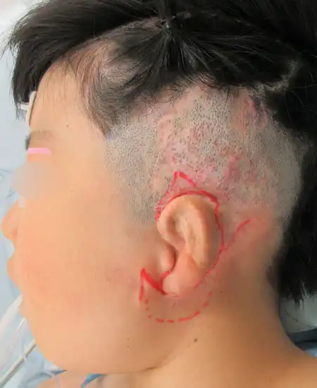 両耳小耳症の左側耳立て修正手術 デザイン（横）