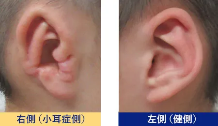 小耳症側の右耳と健側の左耳の比較