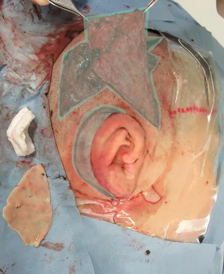 浅側頭筋膜（TPF）を挙上