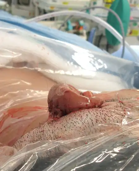 両耳小耳症の左側耳立て修正手術 手術直後 上から