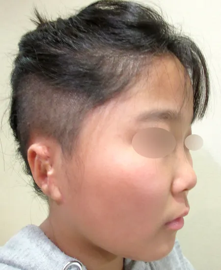 耳立て手術前（斜めから見た状態）