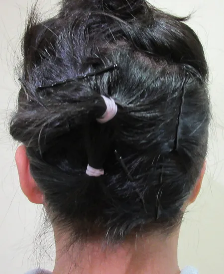 耳立て手術前（背面から見た状態）