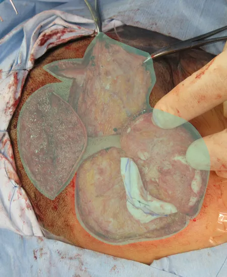 肋軟骨ブロックを耳裏に挿入して浅側頭筋膜（TPF）でカバー