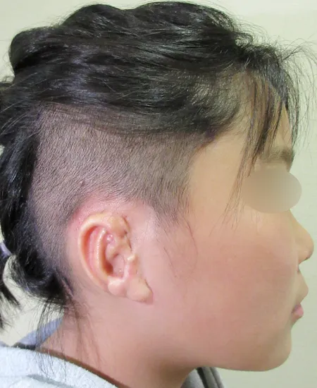 耳立て手術前（側面から見た状態）