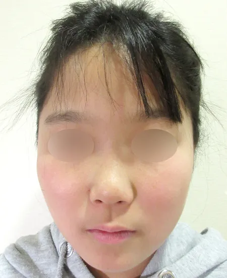 耳立て手術前（正面から見た状態）