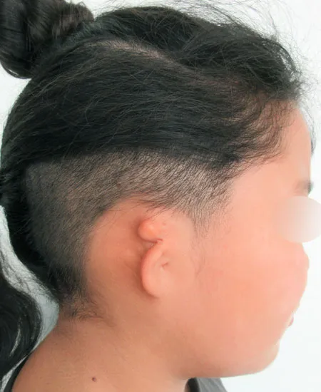 耳垂残存型小耳症（右耳）の最初の状態