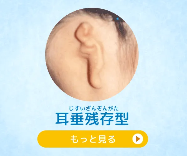 耳垂残存型