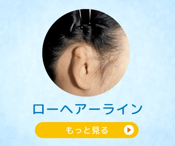 ローヘアーライン