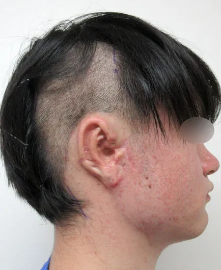 2回目手術前（側面から見た状態）