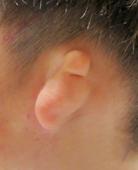 左耳甲介型小耳症の術前