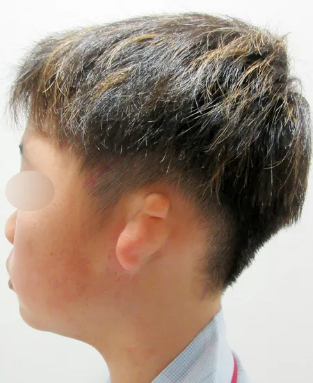 術前（左小耳症側の側面）